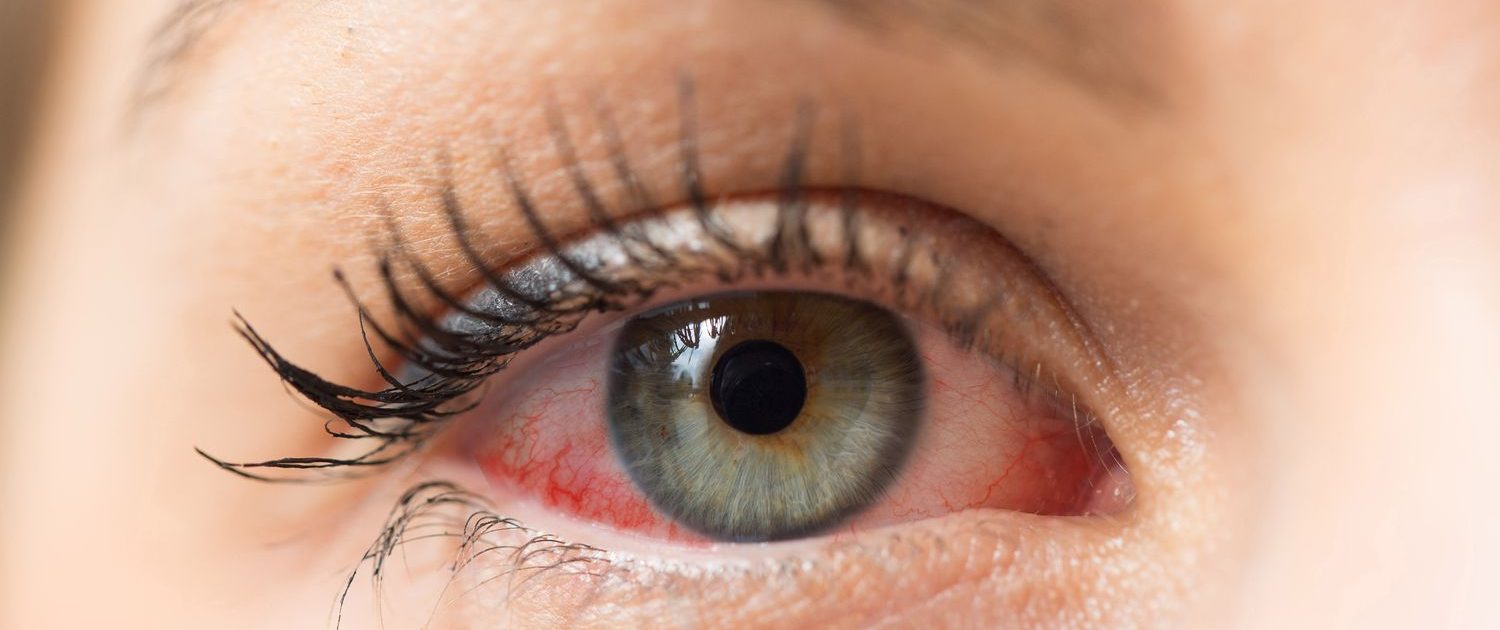 Göz Alerjileri | Türkiye Ulusal Alerji ve Klinik İmmünoloji Derneği