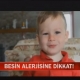 çocuklarda besin alerjisi