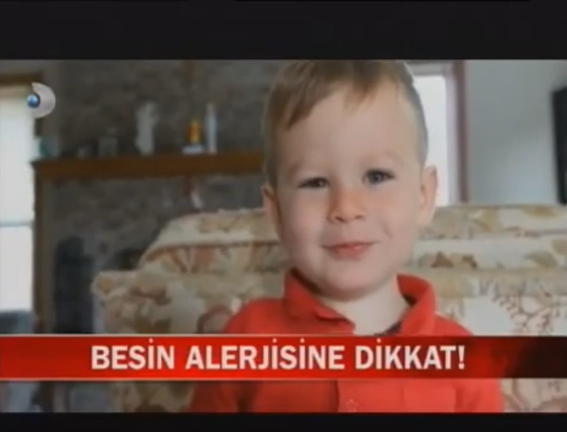 çocuklarda besin alerjisi